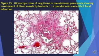 Figure 15 : Microscopic view of lung tissue in pseudomonas pneumonia,showing
involvement of blood vessels by bacteria ,I . e pseudomonas vasculitis & focal
infarction .
 
