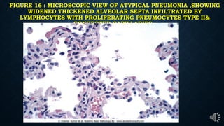 FIGURE 16 : MICROSCOPIC VIEW OF ATYPICAL PNEUMONIA ,SHOWING
WIDENED THICKENED ALVEOLAR SEPTA INFILTRATED BY
LYMPHOCYTES WITH PROLIFERATING PNEUMOCYTES TYPE II&
CONGESTED CAPILLARIES .
 