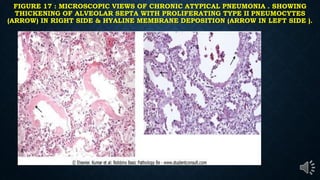 FIGURE 17 : MICROSCOPIC VIEWS OF CHRONIC ATYPICAL PNEUMONIA . SHOWING
THICKENING OF ALVEOLAR SEPTA WITH PROLIFERATING TYPE II PNEUMOCYTES
(ARROW) IN RIGHT SIDE & HYALINE MEMBRANE DEPOSITION (ARROW IN LEFT SIDE ).
 