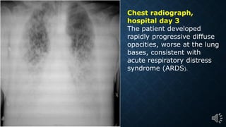 Chest radiograph,
hospital day 3
The patient developed
rapidly progressive diffuse
opacities, worse at the lung
bases, consistent with
acute respiratory distress
syndrome (ARDS).
 