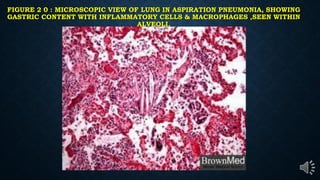 FIGURE 2 0 : MICROSCOPIC VIEW OF LUNG IN ASPIRATION PNEUMONIA, SHOWING
GASTRIC CONTENT WITH INFLAMMATORY CELLS & MACROPHAGES ,SEEN WITHIN
ALVEOLI,
 