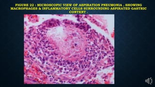 FIGURE 22 : MICROSCOPIC VIEW OF ASPIRATION PNEUMONIA , SHOWING
MACROPHAGES & INFLAMMATORY CELLS SURROUNDING ASPIRATED GASTRIC
CONTENT .
 