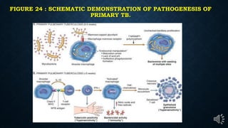 FIGURE 24 : SCHEMATIC DEMONSTRATION OF PATHOGENESIS OF
PRIMARY TB.
 