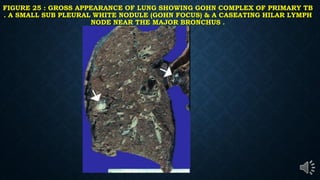 FIGURE 25 : GROSS APPEARANCE OF LUNG SHOWING GOHN COMPLEX OF PRIMARY TB
. A SMALL SUB PLEURAL WHITE NODULE (GOHN FOCUS) & A CASEATING HILAR LYMPH
NODE NEAR THE MAJOR BRONCHUS .
 