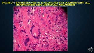 FIGURE 27 : MICROSCOPIC VIEW OF TB GRANULOMA WITH LANGHAN’S GIANT CELL
SHOWING HORESE-SHOE LIKE NUCLEAR ARRANGEMENT .
 
