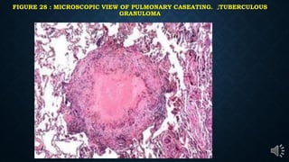 FIGURE 28 : MICROSCOPIC VIEW OF PULMONARY CASEATING. ‫ز‬TUBERCULOUS
GRANULOMA
 