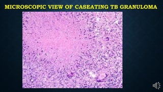 MICROSCOPIC VIEW OF CASEATING TB GRANULOMA
.
 