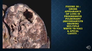 FIGURE 30 :
GROSS
APPEARANCE
OF LUNG IN
PROGRESSIVE
PULMONARY
(SECONDARY)TB
SHOWING
MULTIPLE
WHITE TB FOCI
& APICAL
CAVITY .
 