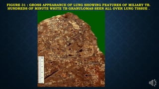 FIGURE 31 : GROSS APPEARANCE OF LUNG SHOWING FEATURES OF MILIARY TB.
HUNDREDS OF MINUTE WHITE TB GRANULOMAS SEEN ALL OVER LUNG TISSUE .
 