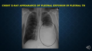 CHEST X-RAY APPEARANCE OF PLEURAL EFFUSION IN PLEURAL TB
 
