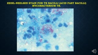 ZEIHL-NEELSEN STAIN FOR TB BACILLI (ACID FAST BACILLI)
MYCOBACTERIUM TB.
 