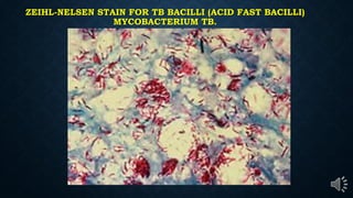 ZEIHL-NELSEN STAIN FOR TB BACILLI (ACID FAST BACILLI)
MYCOBACTERIUM TB.
 