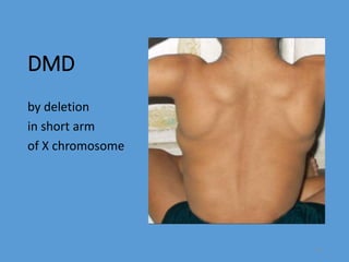 DMD
by deletion
in short arm
of X chromosome
23