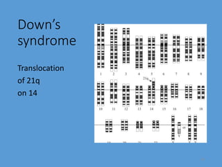 Down’s
syndrome
Translocation
of 21q
on 14
24