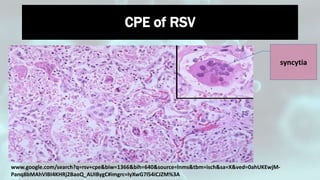 syncytia
CPE of RSV
www.google.com/search?q=rsv+cpe&biw=1366&bih=640&source=lnms&tbm=isch&sa=X&ved=0ahUKEwjM-
Panq8bMAhVIBI4KHRj2BaoQ_AUIBygC#imgrc=IyXwG7l54iCJZM%3A
33
 