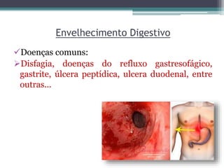 Envelhecimento Digestivo
Doenças comuns:
Disfagia, doenças do refluxo gastresofágico,
gastrite, úlcera peptídica, ulcera duodenal, entre
outras...
 