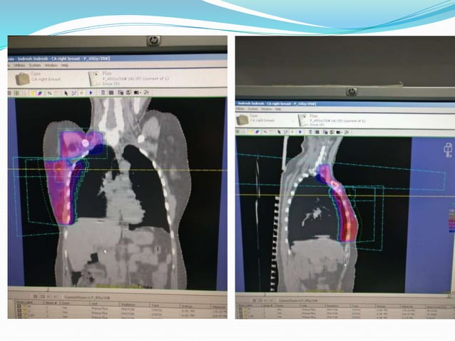 RT breast apbi | PPTX