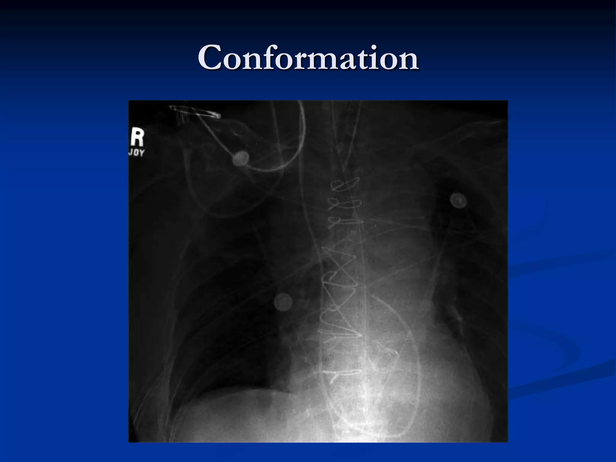 RTC PA CATHETER.ppt | Heart and Cardiovascular Diseases | Diseases and ...