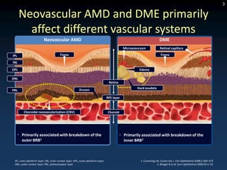 3

      Neovascular AMD and DME primarily
        affect different vascular systems
                           Neovascular AMD                                                                                DME
                                                                                                 Microaneurysm            Retinal capillary

IPL                                       Fovea                                                                            Fovea

INL

OPL                                                                                                       Edema

ONL
                                                                                      Retina

                                                           Drusen                                        Hard exudate
PRL

                                                                                     RPE layer



         Choroidal neovascularization (CNV)                                          Choroid




      • Primarily associated with breakdown of the                                             • Primarily associated with breakdown of the
        outer BRB1                                                                               inner BRB2



 IPL, inner plexiform layer; INL, inner nuclear layer; OPL, outer plexiform layer;                         1. Cummings M, Cunha-Vaz J. Clin Ophthalmol 2008;2:369–375
 ONL, outer nuclear layer; PRL, photoreceptor layer                                                                    2. Bhagat N et al. Surv Ophthalmol 2009;54:1–32
 