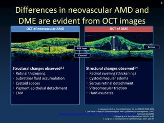 4

 Differences in neovascular AMD and
  DME are evident from OCT images
       OCT of neovascular AMD                                                        OCT of DME



                                                                                                                                  Retina
                                               RPE layer

                                                 Choroid




Structural changes observed1,2                            Structural changes observed3,4
• Retinal thickening                                      • Retinal swelling (thickening)
• Subretinal fluid accumulation                           • Cystoid macular edema
• Cystoid spaces                                          • Serous retinal detachment
• Pigment epithelial detachment                           • Vitreomacular traction
• CNV                                                     • Hard exudates


                                                                      1. Liakopoulos S et al. Invest Ophthalmol Vis Sci 2008;49:5048–5054
                                                       2. The Royal College of Ophthalmologists. AMD: guidelines for management. 2009.
                          http://www.rcophth.ac.uk/docs/publications/AMD_GUIDELINES_FINAL_VERSION_Feb_09.pdf [accessed Sep 2009]
                                                                                          3. Bhagat N et al. Surv Ophthalmol 2009;54:1–32
                                                                             4. Lang GE. In Developments in ophthalmology. 2007. p31–47
 