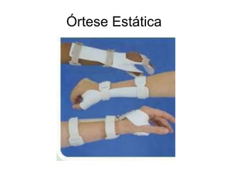 Órtese Estática
 