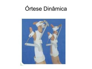 Órtese Dinâmica
 