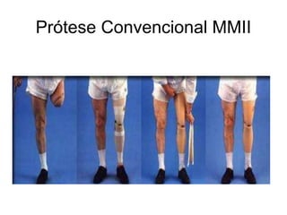 Prótese Convencional MMII
 