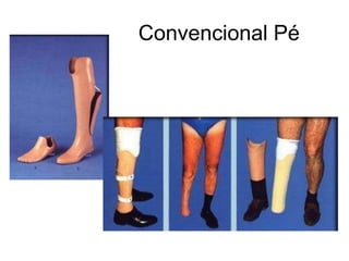 Convencional Pé
 