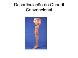 Desarticulação do Quadril
Convencional
 