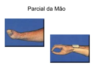 Parcial da Mão
 