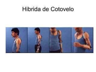 Hibrida de Cotovelo
 