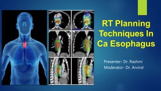 RT Planning
Techniques In
Ca Esophagus
Presenter- Dr. Rashmi
Moderator- Dr. Arvind
 