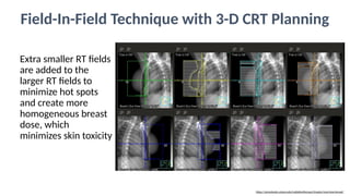 Rt Field RTforBreastCancerSlidesasperASTROguidelines.pptx