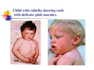 Rubella virus mientayvn.com