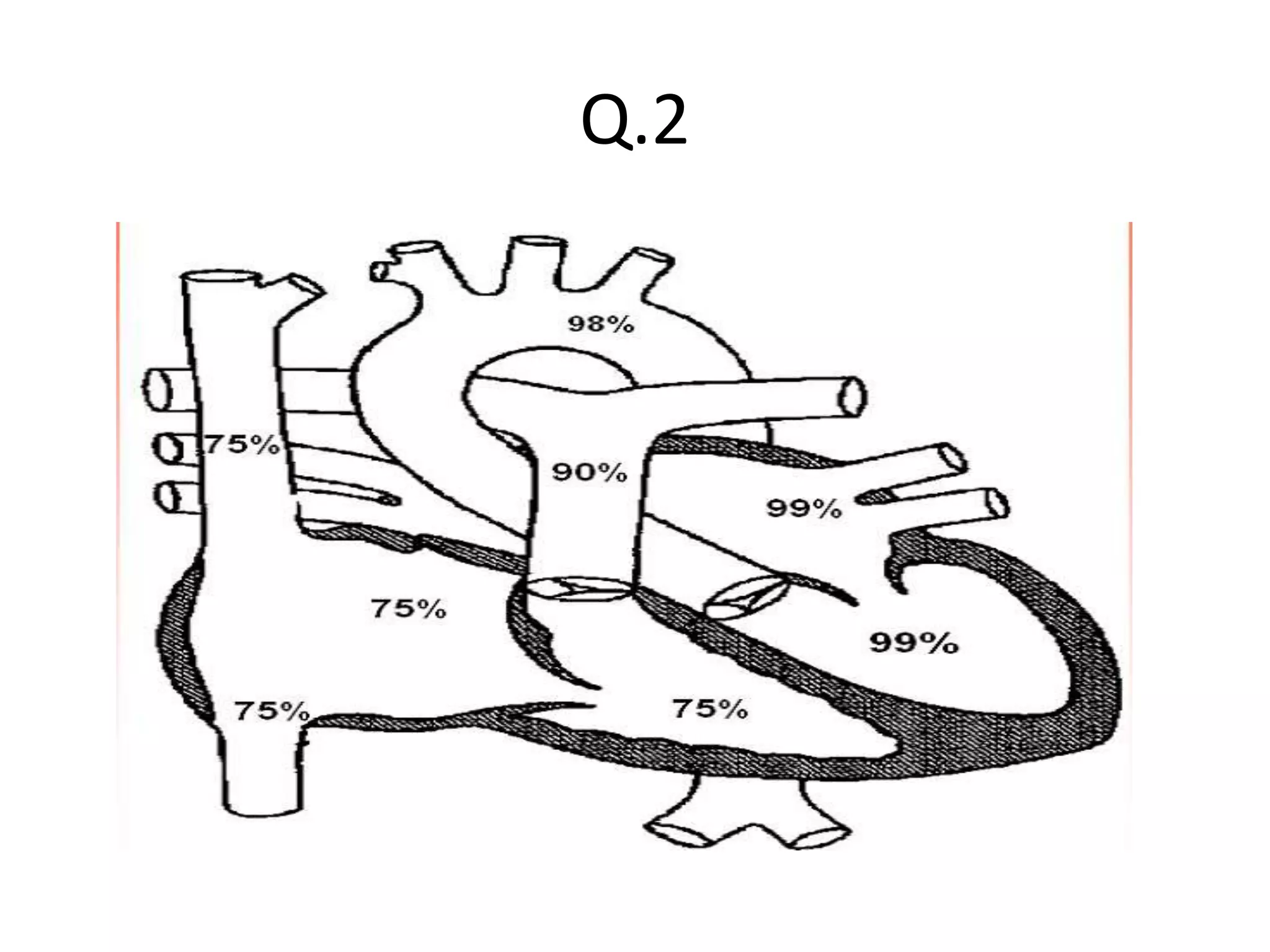 Right heart catheterization | PPSX