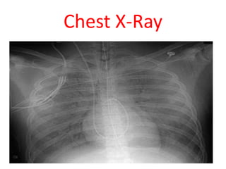 Chest X-Ray
 