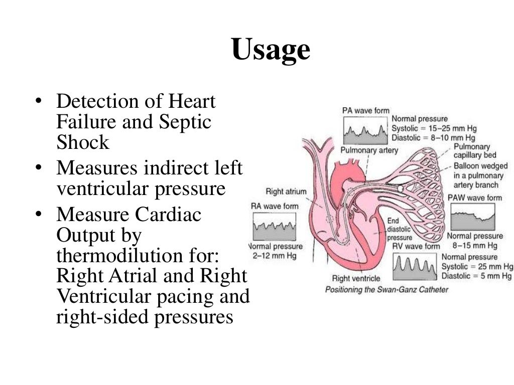 Right heart catheterization