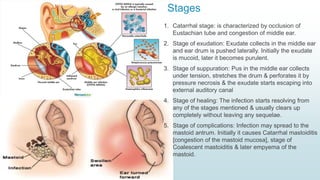 Stages
1. Catarrhal stage: is characterized by occlusion of
Eustachian tube and congestion of middle ear.
2. Stage of exudation: Exudate collects in the middle ear
and ear drum is pushed laterally. Initially the exudate
is mucoid, later it becomes purulent.
3. Stage of suppuration: Pus in the middle ear collects
under tension, stretches the drum & perforates it by
pressure necrosis & the exudate starts escaping into
external auditory canal
4. Stage of healing: The infection starts resolving from
any of the stages mentioned & usually clears up
completely without leaving any sequelae.
5. Stage of complications: Infection may spread to the
mastoid antrum. Initially it causes Catarrhal mastoiditis
[congestion of the mastoid mucosa], stage of
Coalescent mastoiditis & later empyema of the
mastoid.
 
