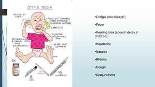 •Otalgia (not always!)
•Fever
•Hearing loss (speech delay in
children)
•Headache
•Nausea
•Rhinitis
•Cough
•Conjunctivitis
 