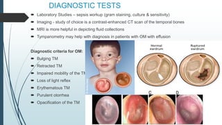 DIAGNOSTIC TESTS
 Laboratory Studies – sepsis workup (gram staining, culture & sensitivity)
 Imaging - study of choice is a contrast-enhanced CT scan of the temporal bones
 MRI is more helpful in depicting fluid collections
 Tympanometry may help with diagnosis in patients with OM with effusion
Diagnostic criteria for OM:
 Bulging TM
 Retracted TM
 Impaired mobility of the TM
 Loss of light reflex
 Erythematous TM
 Purulent otorrhea
 Opacification of the TM
 