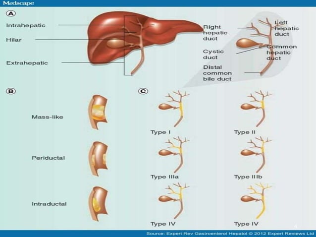 RADIATION THERAPY IN BILIARY TRACT CANCER | PPT