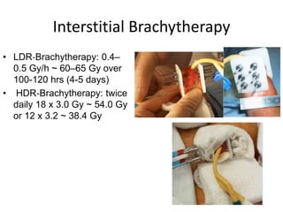 Interstitial Brachytherapy
• LDR‐Brachytherapy: 0.4–
0.5 Gy/h ~ 60–65 Gy over
100-120 hrs (4-5 days)
• HDR‐Brachytherapy: twice
daily 18 x 3.0 Gy ~ 54.0 Gy
or 12 x 3.2 ~ 38.4 Gy
 