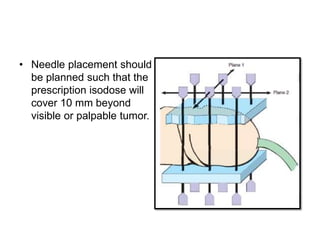 • Needle placement should
be planned such that the
prescription isodose will
cover 10 mm beyond
visible or palpable tumor.
 