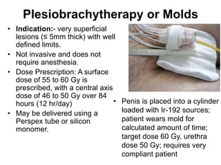 Plesiobrachytherapy or Molds
• Indication:- very superficial
lesions (≤ 5mm thick) with well
defined limits.
• Not invasive and does not
require anesthesia.
• Dose Prescription: A surface
dose of 55 to 60 Gy is
prescribed, with a central axis
dose of 46 to 50 Gy over 84
hours (12 hr/day)
• May be delivered using a
Perspex tube or silicon
monomer.
• Penis is placed into a cylinder
loaded with Ir-192 sources;
patient wears mold for
calculated amount of time;
target dose 60 Gy, urethra
dose 50 Gy; requires very
compliant patient
 
