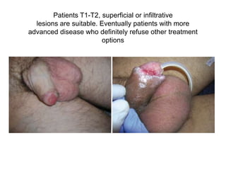 Patients T1-T2, superficial or infiltrative
lesions are suitable. Eventually patients with more
advanced disease who definitely refuse other treatment
options
 