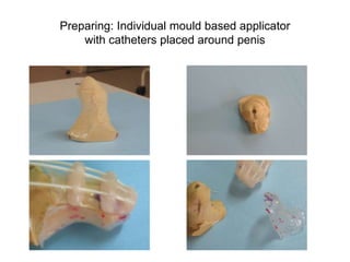 Preparing: Individual mould based applicator
with catheters placed around penis
 