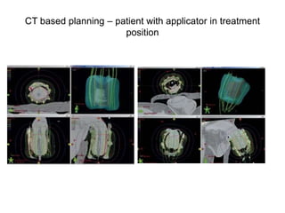 CT based planning – patient with applicator in treatment
position
 
