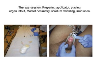 Therapy session: Preparing applicator, placing
organ into it, Mosfet dosimetry, scrotum shielding, irradiation
 