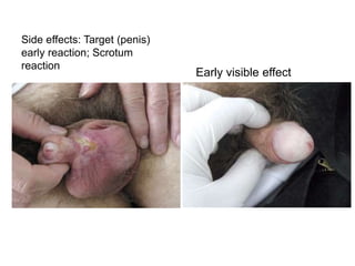 Side effects: Target (penis)
early reaction; Scrotum
reaction
Early visible effect
 