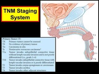 TNM Staging
System
 